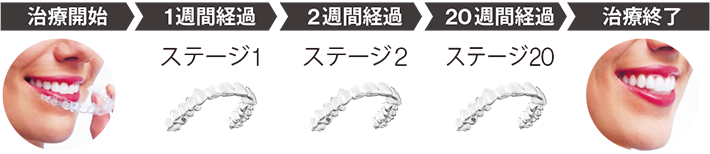 アライナー20ステージで1週間交換の場合の流れ