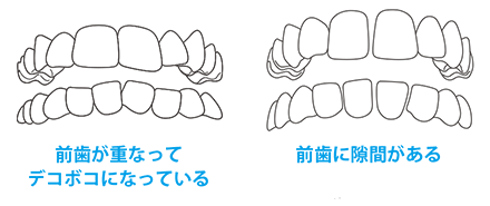 前歯が重なってデコボコになっている　前歯に隙間がある