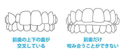 前歯の上下の歯が交叉している　前歯だけ咬み合うことができない